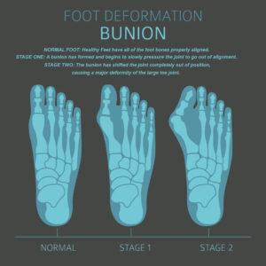 What Are The Best Shoes For Bunions