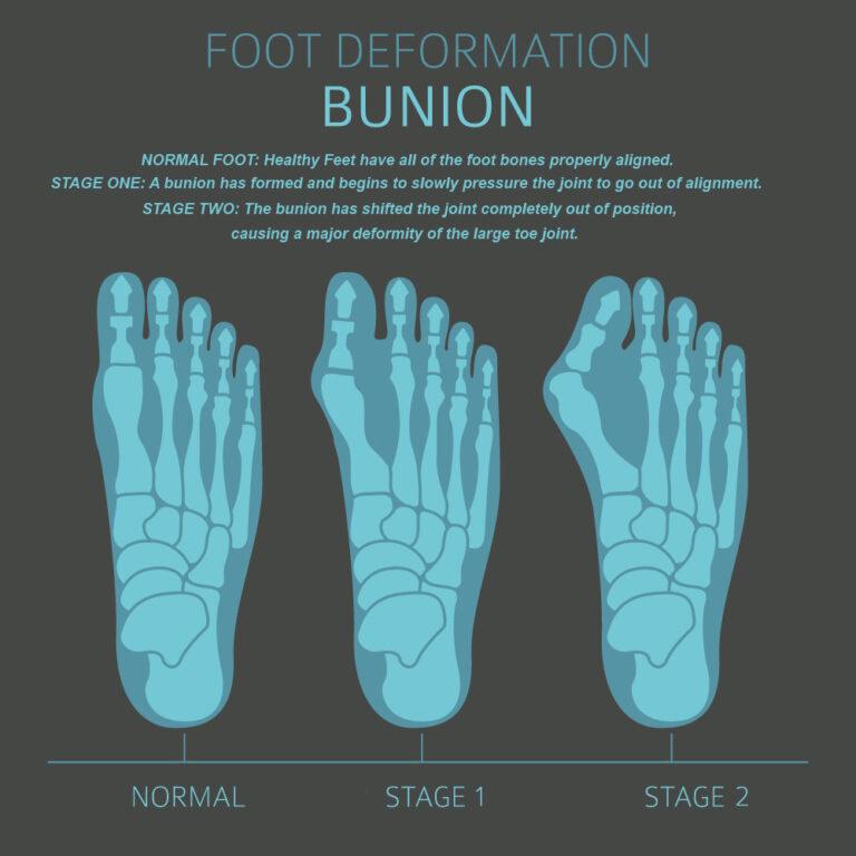 What Are The Best Shoes For Bunions