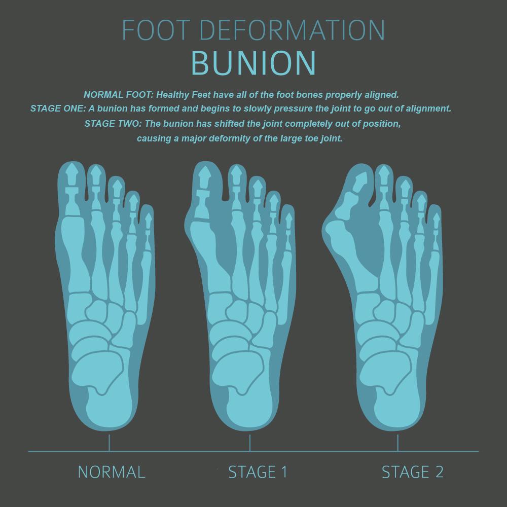 What Are The Best Shoes For Bunions