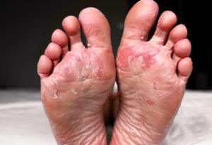 How Long Can Athlete's Foot Live In Shoes