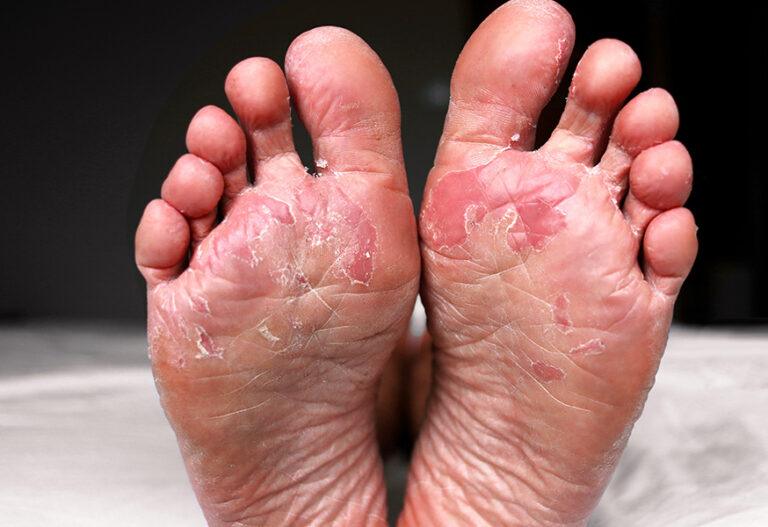 How Long Can Athlete's Foot Live In Shoes